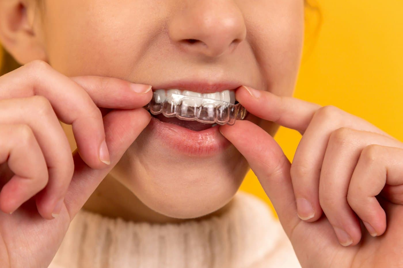 Person fitting a clear orthodontic aligner