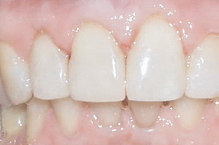 Front teeth after a tooth-coloured composite restoration