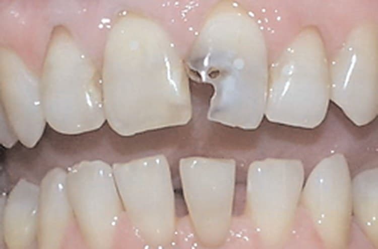Front teeth with a decayed and broken upper incisor before treatment
