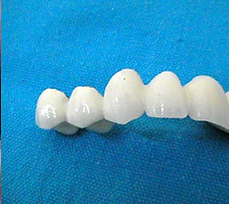 Multi-unit ceramic bridge made in the clinic's laboratory
