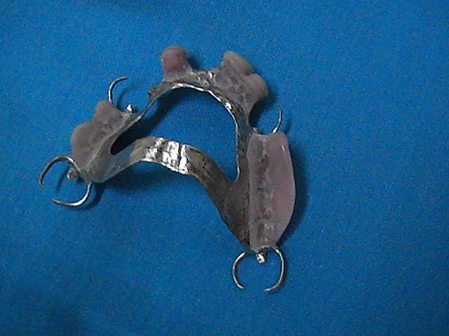 Upper partial denture on a chrome metal frame made by the clinic