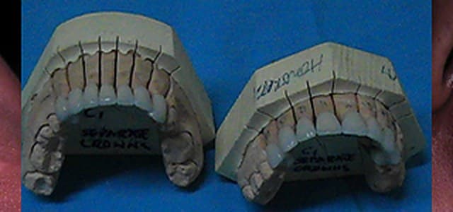 Stone models with ceramic crowns fitted