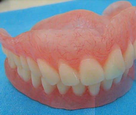 Complete upper and lower acrylic dentures