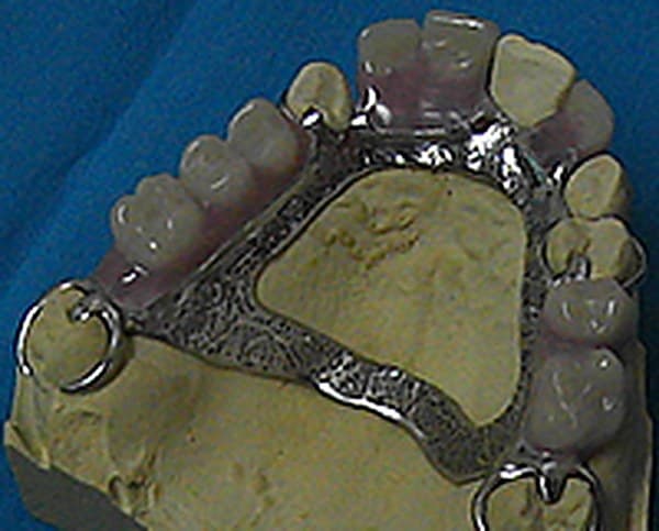 Partial denture with metal framework seated on a stone cast